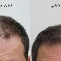 مزوتراپی مو ، ۳۰ درصد تخفیف برای جلسه اول|خدمات آرایشگری و زیبایی|نیشابور, ۲۲ بهمن|دیوار