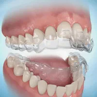 ارتودنسی شفاف(الاینر)لبخندزیبابدون سیم وبراکت|خدمات آرایشگری و زیبایی|گرگان, |دیوار