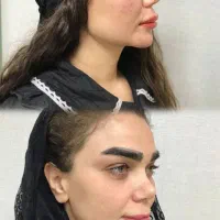 تزریق ژل ،بوتاکس ،لیزر موهای زائد، ساکشن غبعب|خدمات آرایشگری و زیبایی|تهران, صد دستگاه|دیوار