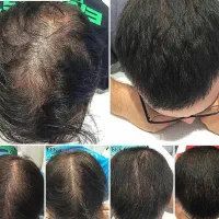 مزوتراپی مو (قطع ریزش)|خدمات آرایشگری و زیبایی|اندیشه, اندیشه فاز ۳|دیوار