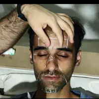 نیازمند مدل بوتاکس و انواع مزوژل و مزو تراپی و prp