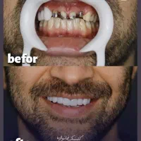ده واحد روکش با دو روکش رایگان