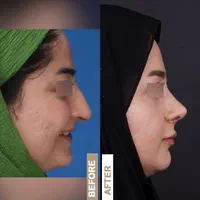 جراحی بینی ابدوساکشن بلفارو(پلک)غبغب تیپ پلاستی|خدمات آرایشگری و زیبایی|مشهد, احمدآباد|دیوار