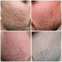 مزوتراپی ، PRP و مزونیدلینگ|خدمات آرایشگری و زیبایی|دوگنبدان, |دیوار