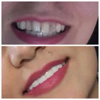 کامپوزیت دندان با بهترین کفیت با قیمتی مناسب|خدمات آرایشگری و زیبایی|یاسوج, |دیوار