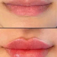 ژل/بوتاکس /فیلر بادی /|خدمات آرایشگری و زیبایی|شیراز, ستارخان|دیوار