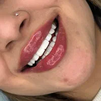 کامپوزیت دندان / لیفت لثه/قرینه سازی