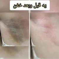 رفع تیرگی ، ناباروری،  چاقی صورت و بدن ، لاغری|آرایشی، بهداشتی، درمانی|زاهدان, |دیوار