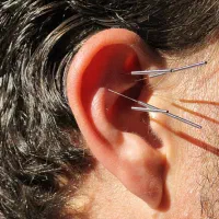 آموزش طب سوزنی  و طب فشاری با گواهینامه معتبر