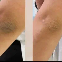 لیزرموهای زائد ،پلاژن تراپی ،کربن صورت (بانوان)|خدمات زیبایی و سلامت|مشهد, شهرک امام هادی (شهرک غرب)|دیوار