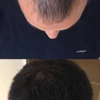 درمان ریزش مو ( تاسی ، سکه ای ، هورمونی )