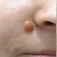برداشتن خال وزگیل،جای آکنه ،جای سوختگی وبخیه|خدمات زیبایی و سلامت|کرمانشاه, |دیوار