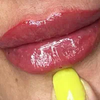 تزریق فیلر و بوتاکس