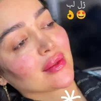 تخفیف ویژه ژل و بوتاکس خدمات زیبای ودرمانی تخصصی