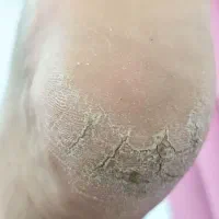 دوست داری ترک پاهات درمان بشه با یه قیمت منصفانه|خدمات آرایشگری و زیبایی|بندر انزلی, نوروزی|دیوار