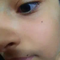 حذف خال ،زگیل فقط با قطره|خدمات آرایشگری و زیبایی|سبزوار, غرب نیروگاه|دیوار