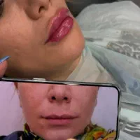 خدمات زیبایی تزریق بوتاکس و فیلر prp مزوژل|استخدام درمانی، زیبایی، بهداشتی|کرمانشاه, |دیوار