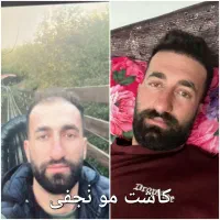 کاشت ابرو ریش مو تراکم بالا باشرایط دلخواه شما