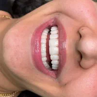 جشنواره اقساطی کامپوزیت لمینیت عصب کشی روکش  EMAX
