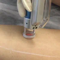 لیزر موی زائد با الکس شاتی بدون ژل، آقا خانم رشت