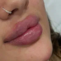 آموزش صفرتا۱۰۰ همه مباحث تزریق فیلر ژل بادی بوتاکس|خدمات آموزشی|شیراز, شریف‌آباد|دیوار