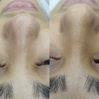 فیشیال تخصصی وپاکسازی پوست|خدمات آرایشگری و زیبایی|بندر کنگان, |دیوار