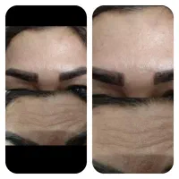 ژل وبوتاکس آنزیم مزو صورت و مو مزونیدلینگ