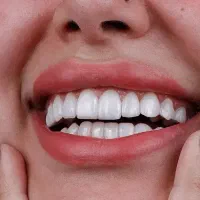 جشنواره ایمپلنت و کامپوزیت با اقساط 6 تا 12 ماه