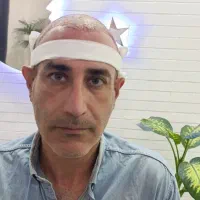 جشنواره کاشت مو