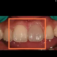 عصکشی دندان جلو۱۲۳ تعرفه دولتی