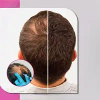 مزوتراپی مو در صحنه