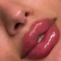 تزریق فیلر بادی ( هیپ دیب، باسن، بیکینی سینه )