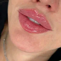 تزریق ژل و بوتاکس