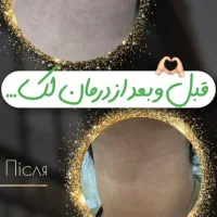 درمان حرفه‌ای لک و کک‌ومک  و مزو تراپی