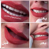 دندانسازی سکندری کرمان دندان ایتالیایی لثه نرم|خدمات آرایشگری و زیبایی|کرمان, |دیوار