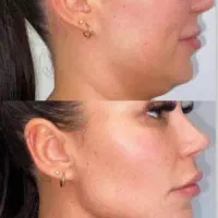 تزریق ژل و بوتاکس