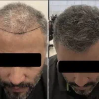 آفرویژه  کاشت مو وابرو ب مدت دوهفته