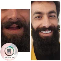 دست دندان متحرک کامل میخوای(کشیدنتون رایگان)|خدمات آرایشگری و زیبایی|شیراز, کاراندیش|دیوار