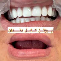 فلکسیبل دَندان مَصنوعی تکه ای ژله ای دَنداًنسازی|خدمات آرایشگری و زیبایی|یزد, |دیوار