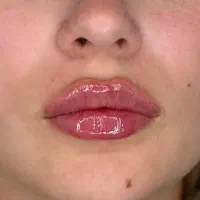 تزریق ژل لب روسی فیلربادی بوتاکس لیفت نخ کانتورینگ