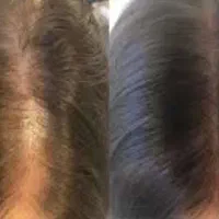 با تکنیک میکرواسکالپ،کم پشتی مو دیگه دیده نمیشه|خدمات آرایشگری و زیبایی|شاهین‌شهر, فردوسی|دیوار