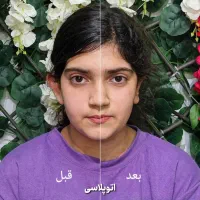 عمل جراحی پلک(بلفاروپلاسی)جراحی گوش(اتوپلاسی)|خدمات زیبایی و سلامت|تهران, آبشار تهران (دریاچه)|دیوار