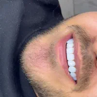 کامپوزیت دندان.تخفیف.یلدایی