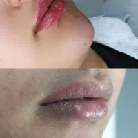 تزریق ژل و بوتاکس