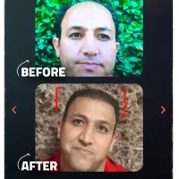 کاشت تخصصی مو و ابرو ، ضمانت کتبی
