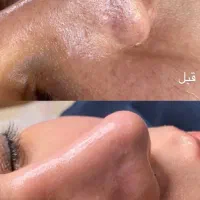 پاکسازی،فیشال درمان مشکلات پوستی|خدمات آرایشگری و زیبایی|زابل, |دیوار