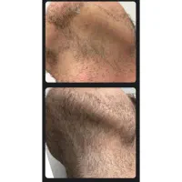 پرپشتی ریش بدون کاشت و خون ریزی|آرایشی، بهداشتی، درمانی|مرودشت, بیست متری بیمارستان|دیوار