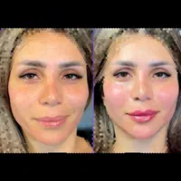 تزریق ژل و بوتاکس و فیلر بادی