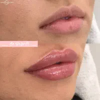 جشنواره ژل و بوتاکس فیلر دکتر شریفی (آفر ویژه)