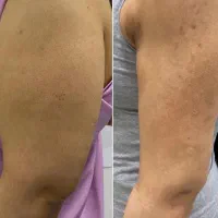 جشنواره تخفیفی لیپوماتیک بلفاروپلاستی و لیپوبازو|خدمات آرایشگری و زیبایی|تهران, ونک|دیوار